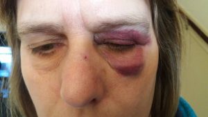 Vrouw mishandeld in Petten