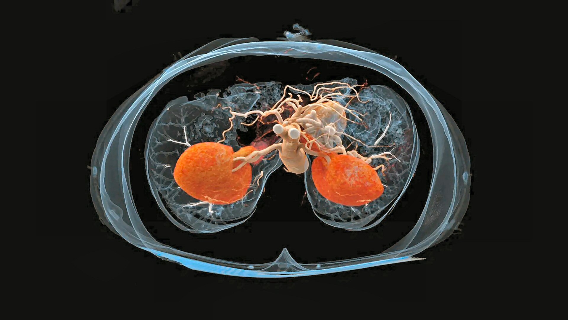 NWZ-informatieavond over niertransplantatie